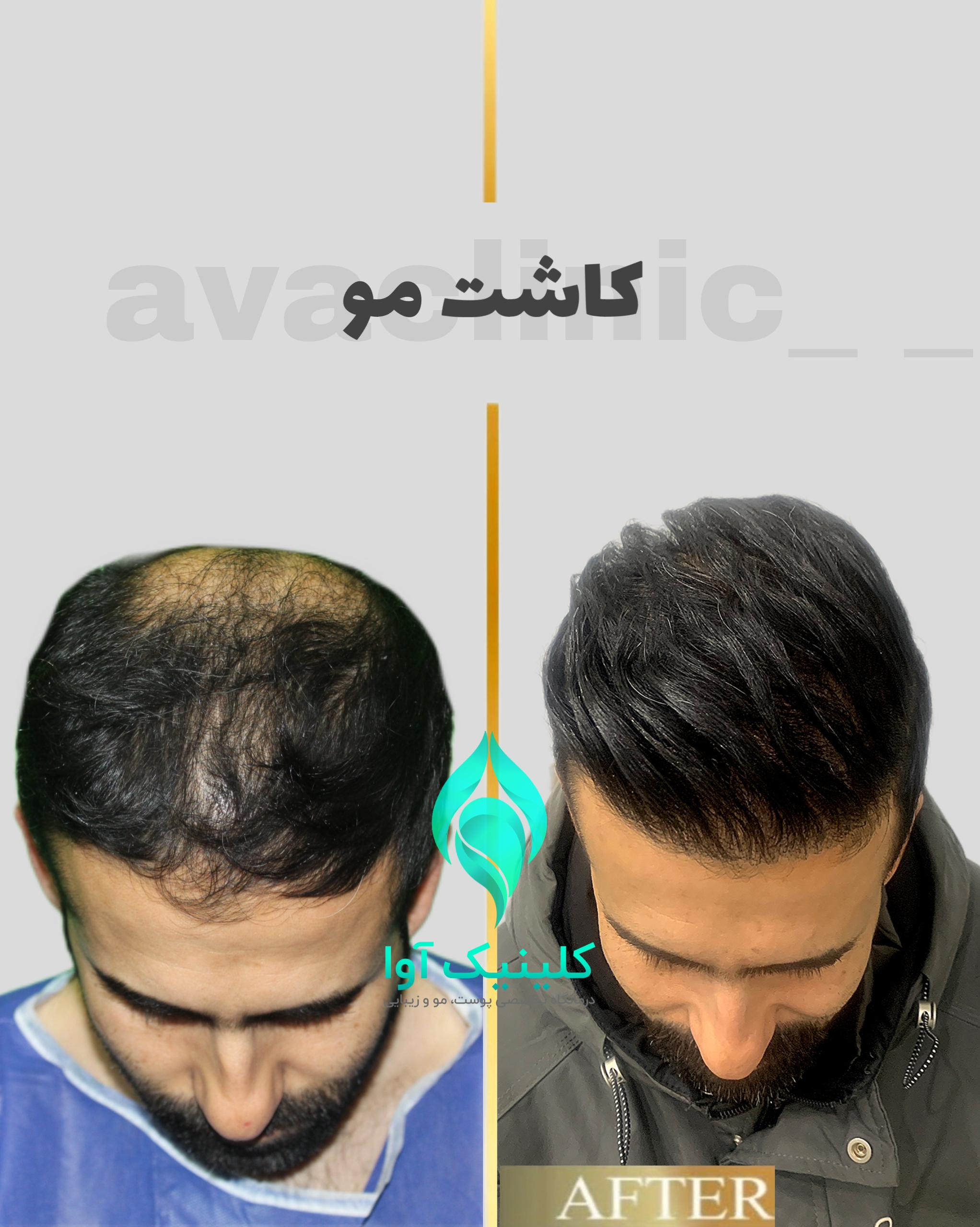کلینیک تخصصی پوست و کاشت مو آوا